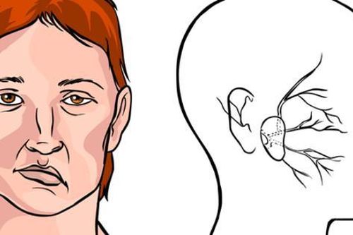 Thường xuyên làm những điều này trong lúc giao mùa, gia tăng nguy cơ liệt dây thần kinh số 7