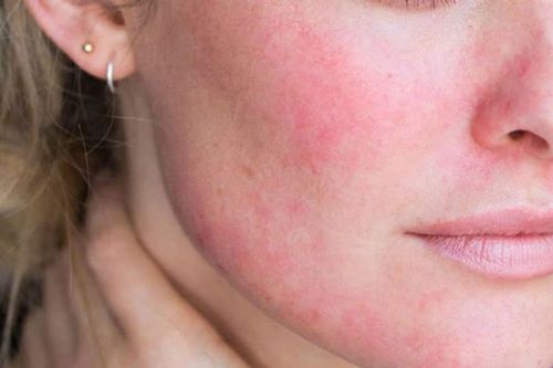 Dấu hiệu da kích ứng và cách khắc phục