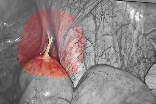 Tổn thương đường tiêu hóa do thói quen ngậm tăm