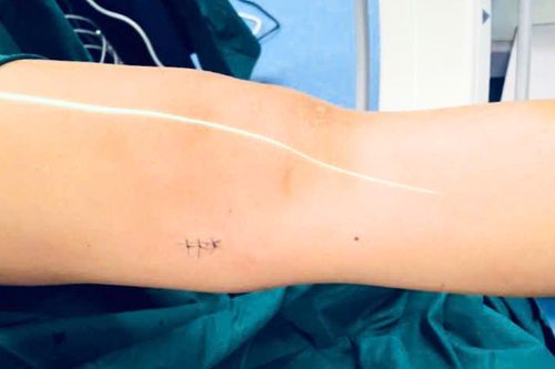 Phẫu thuật chỉnh xương gãy cho bé trai bằng phương pháp hiện đại