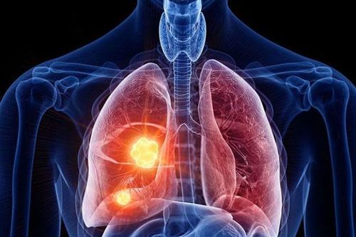 Bệnh bụi phổi có thể hồi phục không?