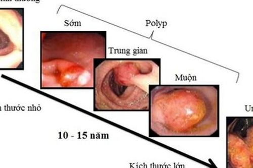Người đàn ông ở Phú Thọ phát hiện mắc ung thư trực tràng từ một dấu hiệu nhiều người Việt bỏ qua