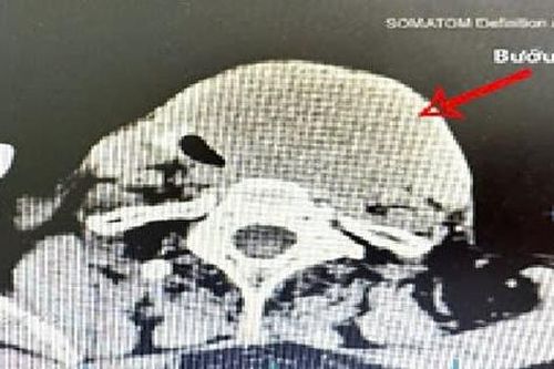 Khó thở, nuốt nghẹn vì bướu tuyến giáp 40 năm không điều trị
