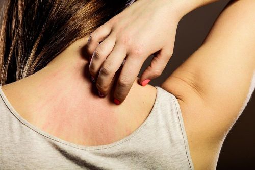 Vì sao luôn cảm thấy ngứa dù đã tắm sạch sẽ