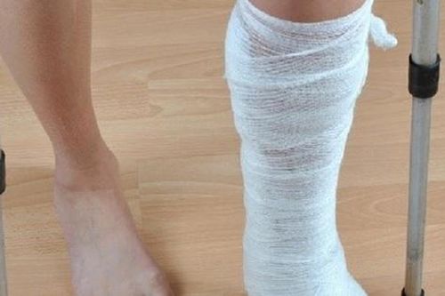 Bài tập phục hồi chức năng cho người bệnh gãy xương