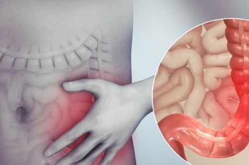 Uống mấy tách cà phê mỗi ngày giúp giảm nguy cơ tái phát ung thư ruột?