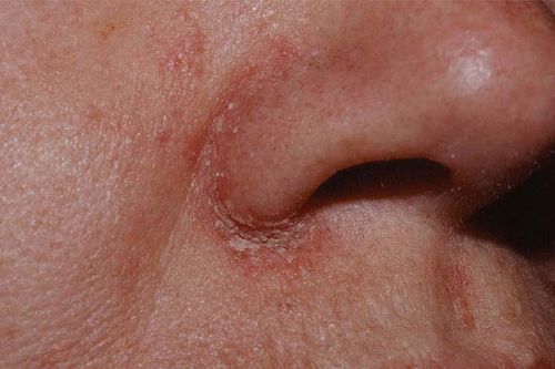 Một số bệnh gây bong da, đóng vảy vào mùa đông, khắc phục như thế nào?