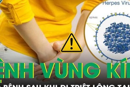 Lây bệnh khó nói cho chồng sau khi đi triệt lông vùng kín