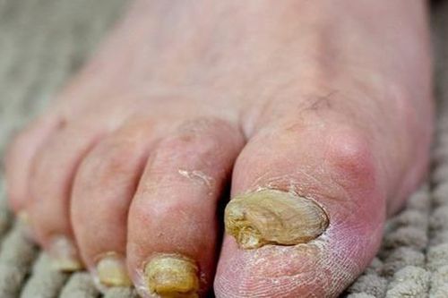 Nấm móng: Nguyên nhân, triệu chứng, lây truyền và cách điều trị