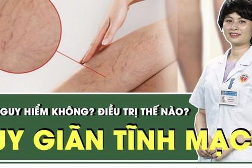 Suy giãn tĩnh mạch điều trị thế nào?