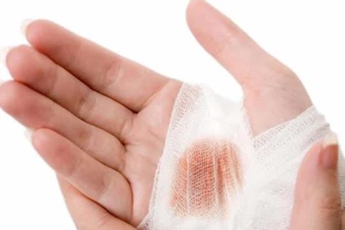 Cách cầm máu vết thương nhanh chóng, hiệu quả