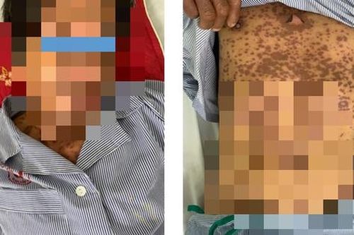 Uống thuốc trị nhiệt miệng, người đàn ông đi cấp cứu trong tình trạng lở loét toàn thân