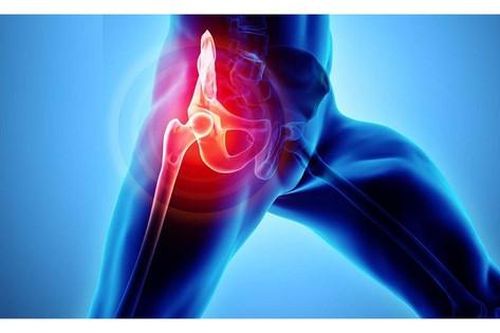 Trẻ sưng đau vùng háng, khó ngồi, cảnh giác với viêm khớp háng