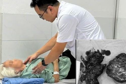 Phẫu thuật thành công cho bệnh nhân cao tuổi bị bướu giáp khổng lồ 30 năm