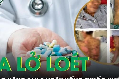 Da lở loét, bong tróc mảng lớn sau 2 ngày uống thuốc nhiệt miệng