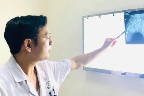 Mổ thay khớp háng có tốt không, để lại những biến chứng gì?