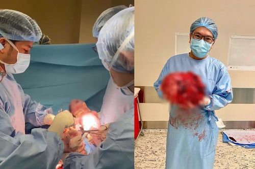 Thai nhi chào đời khỏe mạnh trong khối u xơ nặng 8kg