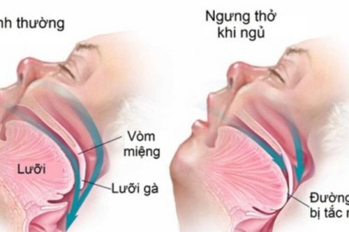 Dấu hiệu cảnh báo hội chứng nguy hiểm ngưng thở khi ngủ