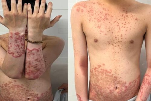 Tự điều trị thuốc không rõ nguồn gốc, người bệnh nhiễm nấm lan tỏa toàn thân