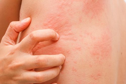 Ngứa cảnh báo tình trạng nguy hiểm không chỉ là bệnh ngoài da khi trời hanh khô