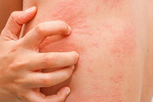Tin tức Đời sống 8/11: Ngứa cảnh báo tình trạng nguy hiểm không chỉ là bệnh ngoài da