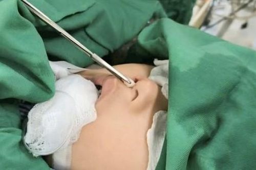Hiếm gặp: Bé trai 4 tuổi có răng mọc ở mũi