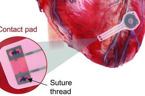 Máy tạo nhịp tim dạng tiêm