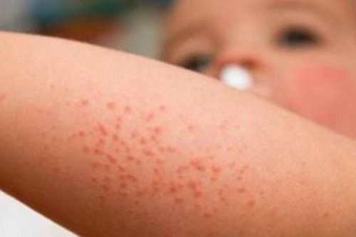 Bác sĩ tại nhà: Sơ cứu nhanh khi trẻ bị dị ứng hải sản