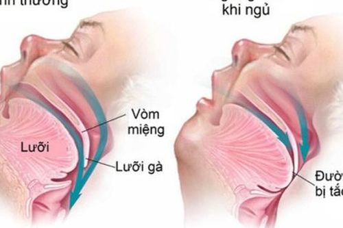 Hay buồn ngủ ban ngày, ngủ ngáy, mệt mỏi khi thức dậy, cần lưu ý hội chứng nguy hiểm này