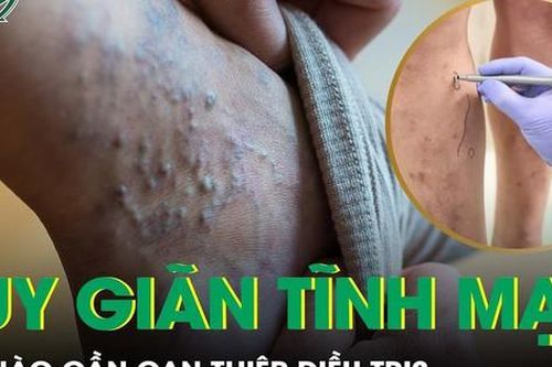 Khi nào cần can thiệp điều trị suy giãn tĩnh mạch?