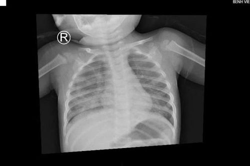Bé trai 1 tuổi ở TP.HCM nhập viện vì hít dầu để thắp đèn