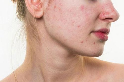 Những thói quen sai lầm khiến da bạn không thể sạch mụn