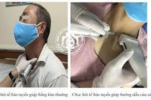 Chọc hút tế bào bằng kim nhỏ có đưa ra kết quả chính xác?