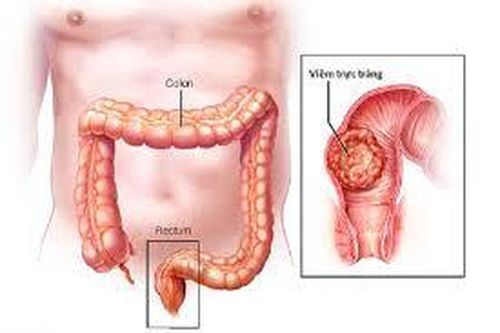 Trực tràng bị viêm và vôi hóa có cần phải sinh thiết?