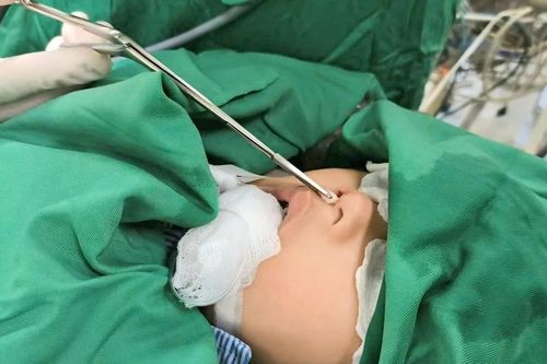 Hy hữu: Răng mọc ở mũi bé trai 4 tuổi