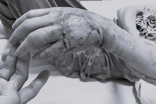 Suýt mất bàn tay chỉ vì chủ quan với nốt phồng nhỏ