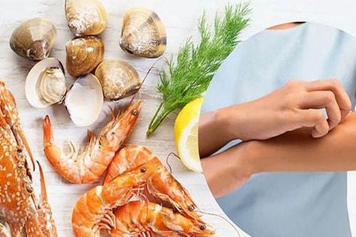 Không chủ quan với dị ứng hải sản
