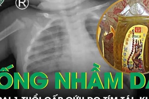 Bệnh nhi 1 tuổi tím tái khó thở sau khi uống nhầm dầu hương liệu