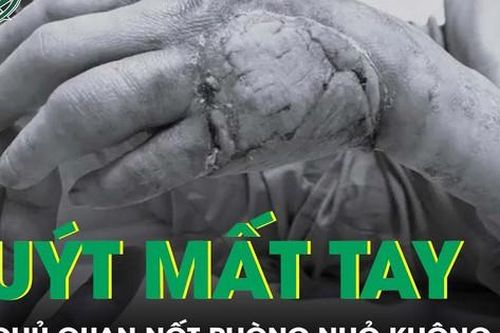 Chủ quan nốt phồng nhỏ, người phụ nữ suýt mất tay do hoại tử
