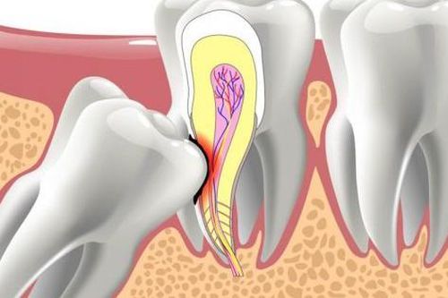 Răng mọc lạc chỗ có dấu hiệu gì?