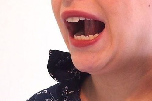Bài tập cho người mắc hội chứng đau nhức vùng sọ mặt