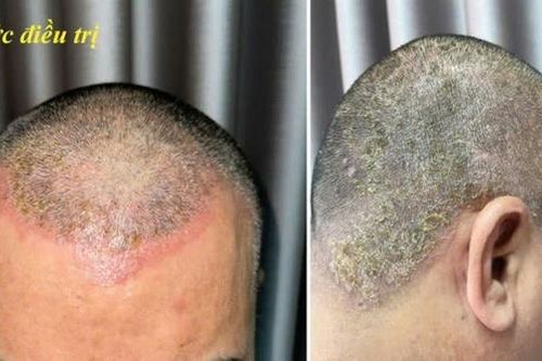 Dị ứng da đầu do thuốc nhuộm tóc
