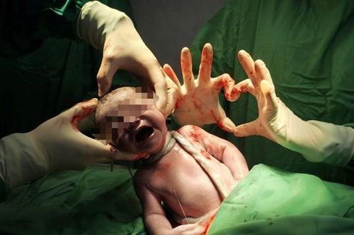 Em bé chào đời với tràng hoa quấn cổ 3 vòng