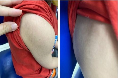 Suy tuyến thượng thận do tự ý dùng 'thuốc đông y tăng cân'