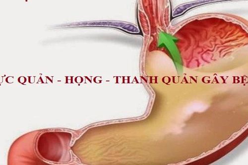 Cách phát hiện và xử lý viêm thanh quản trào ngược