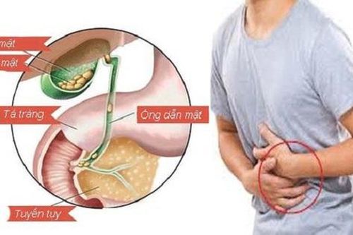 Sỏi mật khi nào cần phải mổ?
