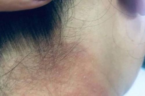 Kiến ba khoang vào mùa, bác sĩ chỉ cách xử trí đúng