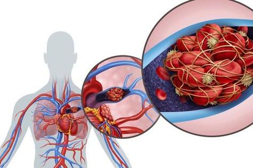 Phương pháp mới dự đoán nguy cơ thuyên tắc mạch phổi