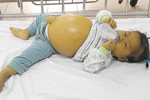 Lặng người khi nhìn bé gái 2 tuổi với cái bụng như chực 'nổ tung'
