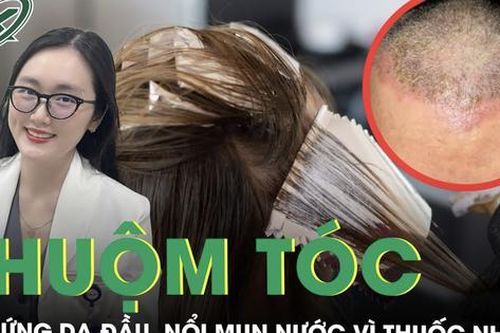 Da đầu ửng đỏ chi chít mụn nước vì dị ứng thuốc nhuộm tóc
